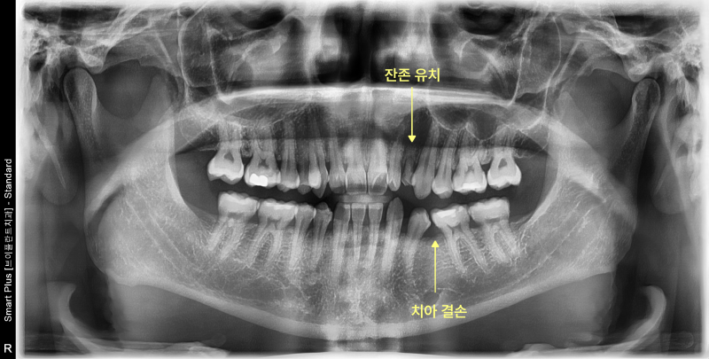 성인 환자의 파노라마 방사선 사진, 잔존 유치와 치아 결손 부위 표시
