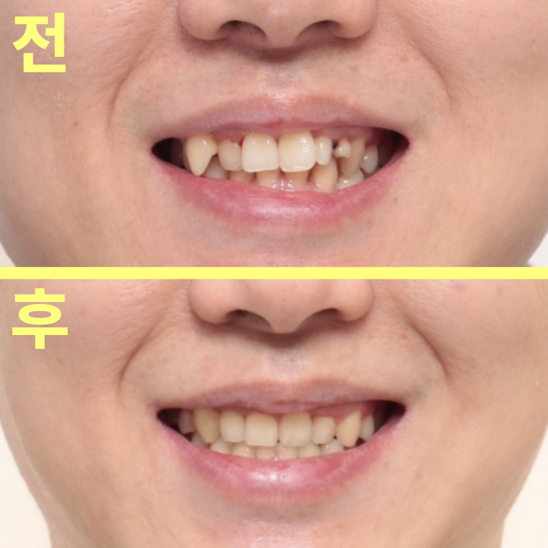 대구수성구치과 성인 유치와 영구치 결손, 교정부터 임플란트까지 관련 사진 21
