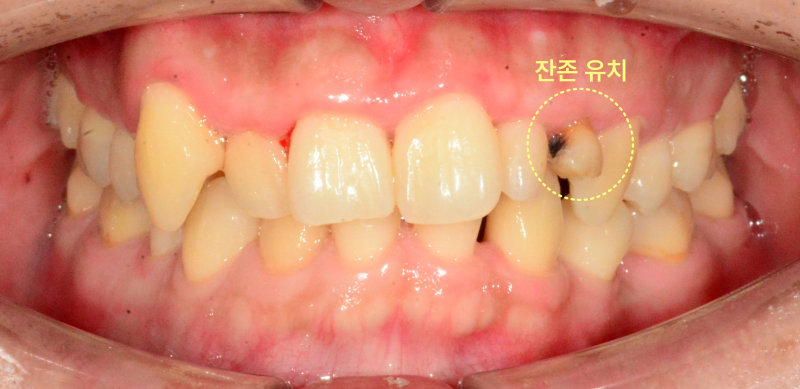 성인 환자의 상악 전치부 구강 내 사진, 잔존 유치와 충치 표시