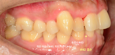 성인 환자의 하악 좌측 구치부 구강 내 사진, 치아 결손 부위 표시