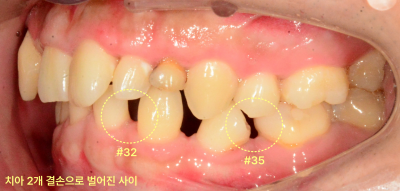 성인 환자의 하악 우측 구치부 구강 내 사진, 치아 결손 부위 표시