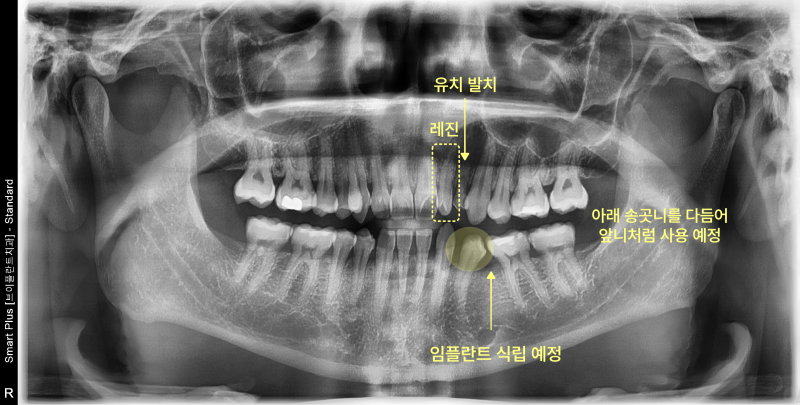 성인 환자의 파노라마 방사선 사진, 유치 발치 및 임플란트 식립 예정 부위 표시