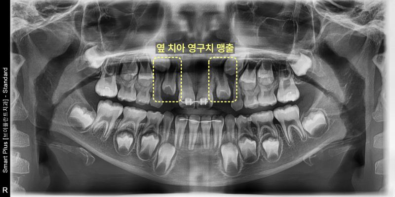 어린이 환자의 파노라마 방사선 사진. 위 앞니 주변의 영구치 맹출 상태가 노란색 점선 사각형으로 강조되어 있다.