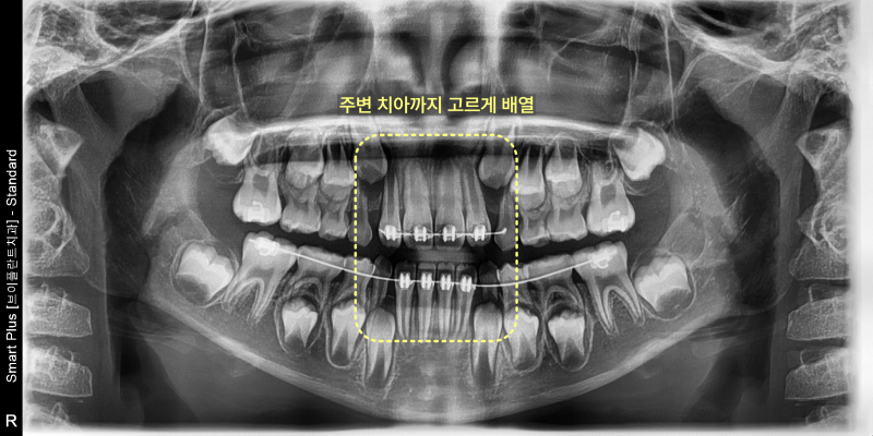 어린이 환자의 파노라마 방사선 사진. 교정 장치 부착 후 주변 치아까지 고르게 배열된 모습이 노란색 점선 사각형으로 강조되어 있다.