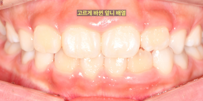 어린이 환자의 구강 내 정면 사진. 위 앞니가 가지런하게 배열되어 있으며, 전반적인 치열이 고른 모습이다.