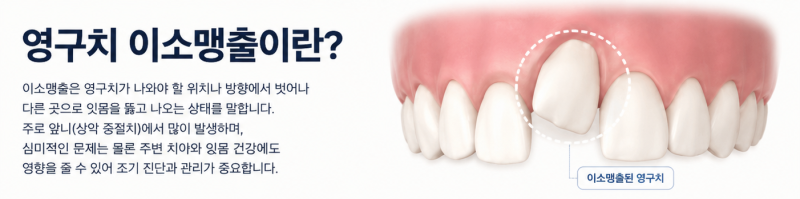 영구치 이소맹출의 개념을 설명하는 치아 모형 일러스트. 잇몸을 뚫고 비정상적인 위치에 맹출한 영구치 모습.