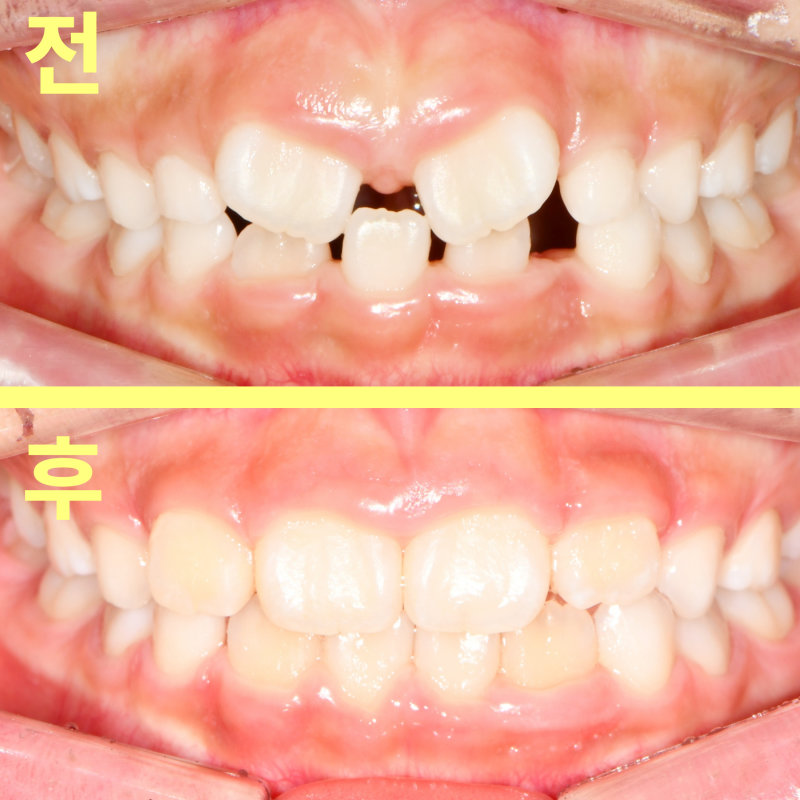대구교정치과 아이 앞니 교정 언제 시작할까요 관련 사진 26