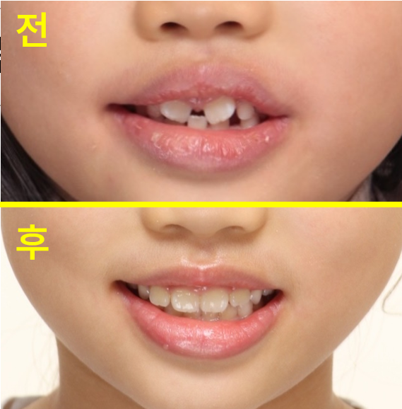 대구교정치과 아이 앞니 교정 언제 시작할까요 관련 사진 27