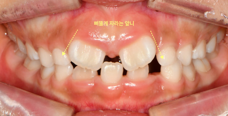 어린이 환자의 구강 내 정면 사진. 위 앞니 두 개가 삐뚤게 자라난 모습이 노란색 화살표로 표시되어 있다.