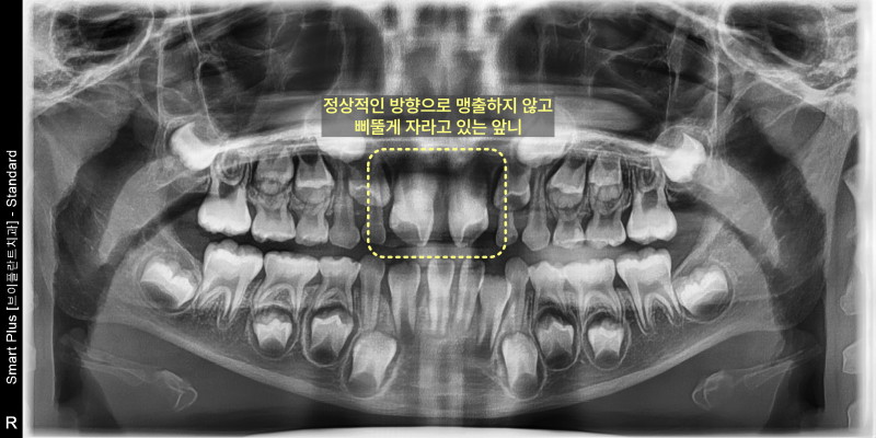 어린이 환자의 파노라마 방사선 사진. 위 앞니가 정상적인 방향으로 맹출하지 않고 삐뚤게 자라고 있는 모습이 노란색 점선 사각형으로 강조되어 있다.