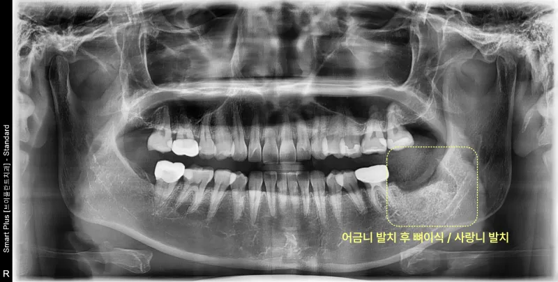발치 후 환자의 파노라마 방사선 사진