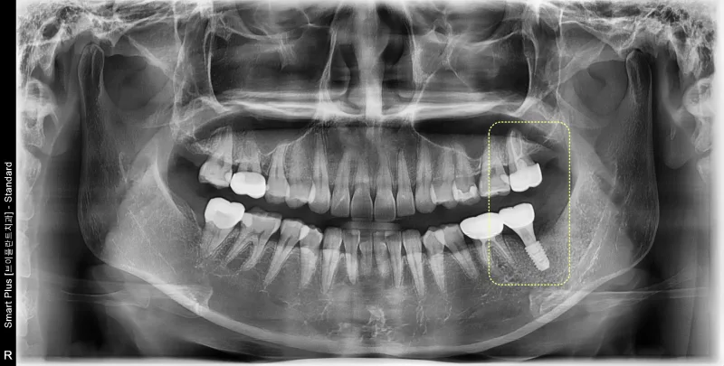 임플란트 보철물 장착 후 환자의 파노라마 방사선 사진