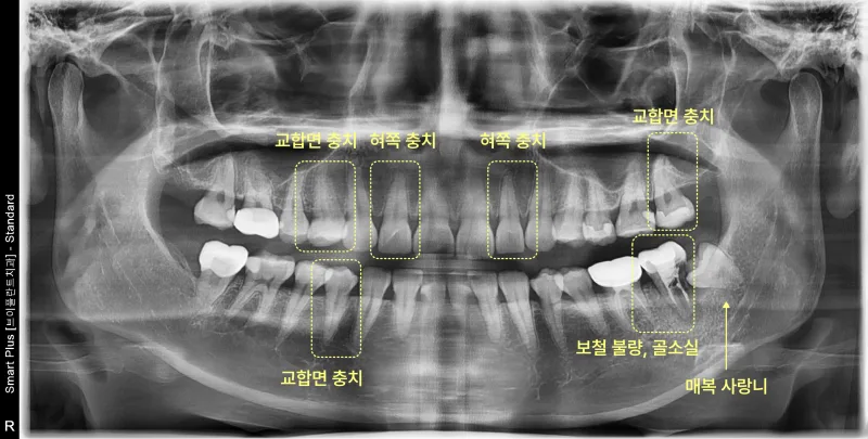 환자의 파노라마 방사선 사진