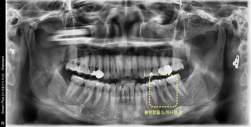 환자의 치아 전체를 촬영한 파노라마 방사선 사진. 좌측 아래 어금니 부위에 노란색 점선으로 사각형 표시가 되어 있다.
