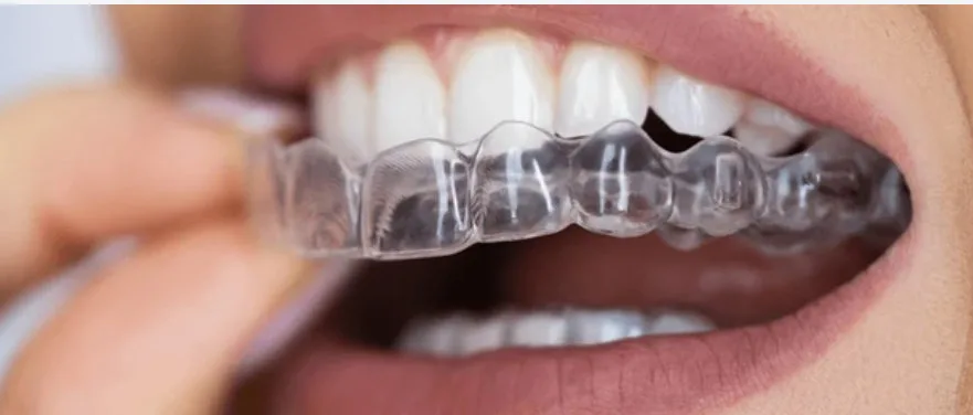 여성의 입에 투명 교정 장치를 착용하는 모습
