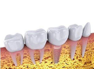잇몸뼈에 임플란트가 식립된 모습을 보여주는 치아 모형의 3D 렌더링 이미지