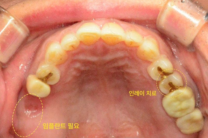 치아의 위턱면을 위에서 아래로 내려다본 모습. 우측 어금니에 인레이 치료가 되어 있고, 좌측 어금니 한 개가 빠져 있다.