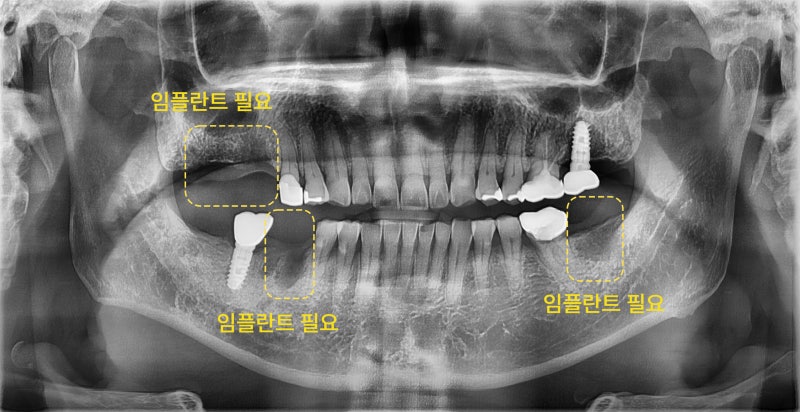 환자의 파노라마 방사선 사진. 좌측 아래 어금니 두 개와 우측 아래 어금니 한 개가 빠져 있고, 좌측 위 어금니 한 개가 빠져 있다.