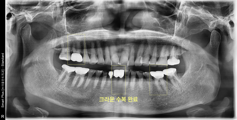 크라운 수복 완료 후 파노라마 방사선 사진