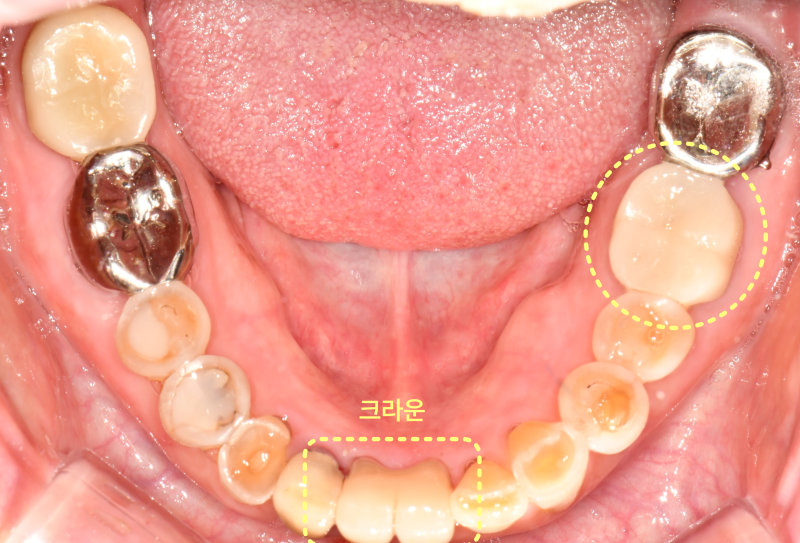 크라운 및 레진 수복 완료 후 환자의 하악 치아 교합면 사진