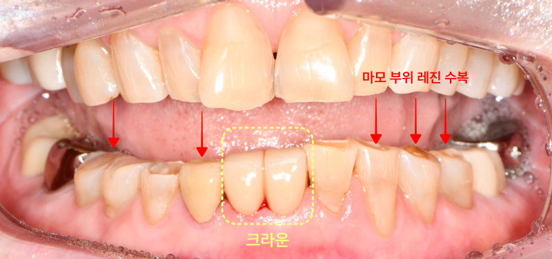 크라운 및 레진 수복 완료 후 환자의 전치부 치아 정면 사진