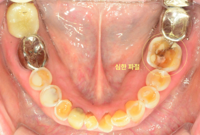 환자의 하악 치아 교합면 사진