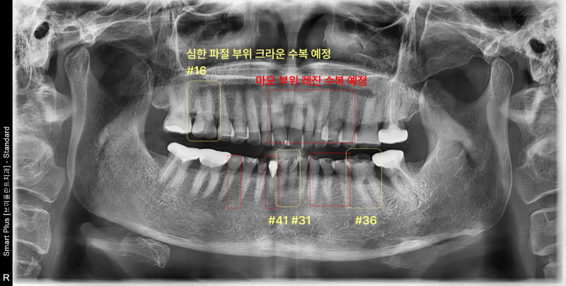 치료 계획이 표시된 파노라마 방사선 사진