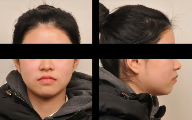 치아교정 후 환자의 얼굴 정면과 측면 사진, 눈과 코 부분은 가려져 있음