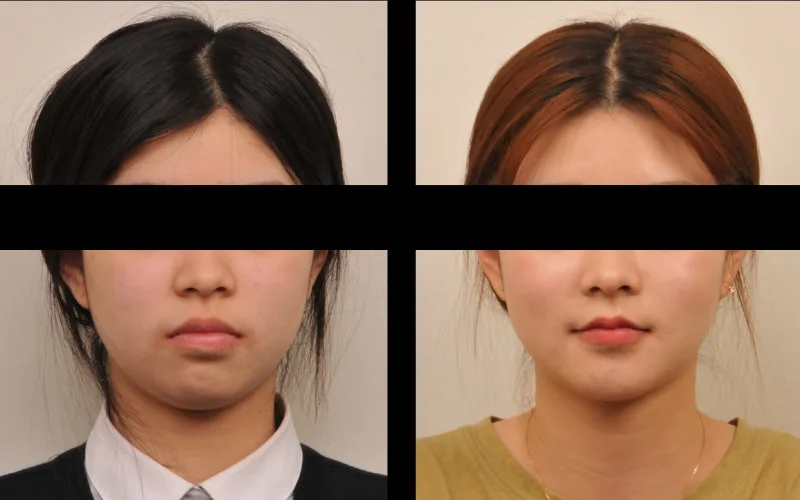 치아교정 전후 환자의 얼굴 정면 사진 비교, 눈과 코 부분은 가려져 있음