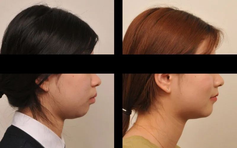 수성구치과 복잡한 치아교정, 성공적인 결과를 위한 선택 기준 관련 사진 21