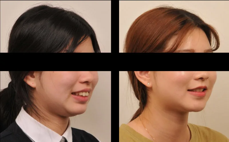 수성구치과 복잡한 치아교정, 성공적인 결과를 위한 선택 기준 관련 사진 22