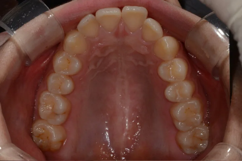 위에서 아래로 촬영한 환자의 상악 치아 구강 내 사진