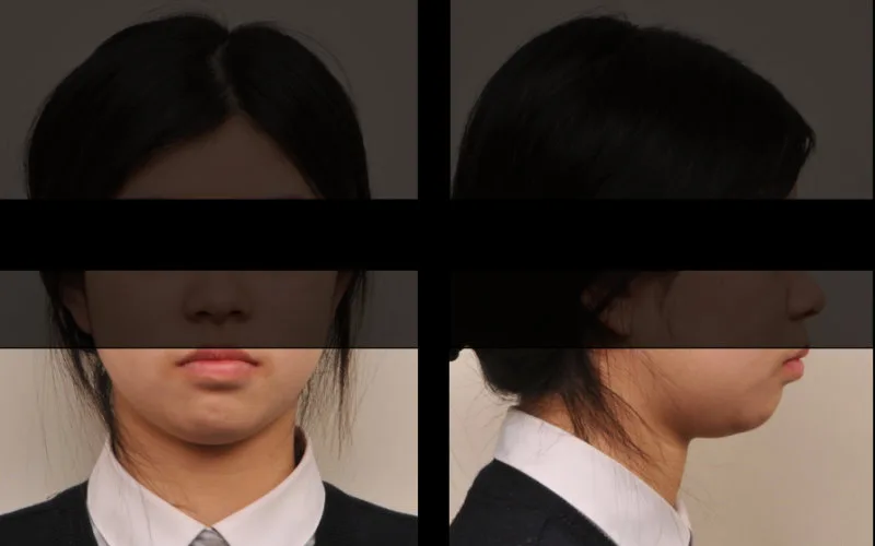 환자의 얼굴 정면과 측면 사진, 눈과 코 부분은 가려져 있음