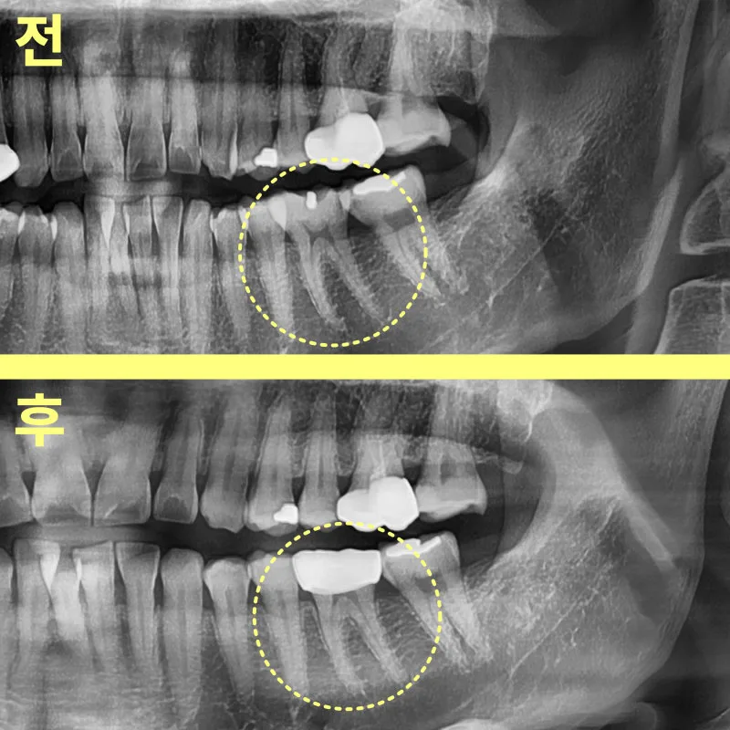 상단에는 치료 전, 하단에는 치료 후 하악 좌측 어금니 부위를 보여주는 파노라마 방사선 비교 사진