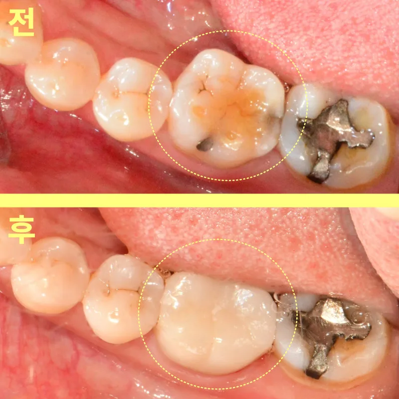 상단에는 치료 전, 하단에는 치료 후 하악 좌측 어금니를 보여주는 구강 내 비교 사진