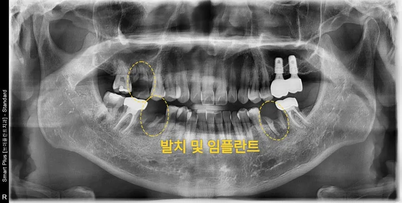 치아 교정 전 발치 및 임플란트 계획을 보여주는 파노라마 방사선 사진