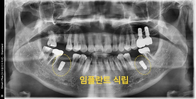 임플란트 식립 후 파노라마 방사선 사진