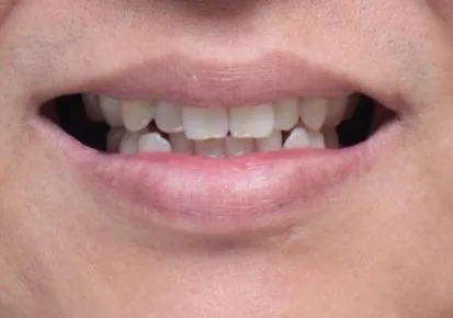치아 교정 전 환자의 입술과 치아 정면 사진