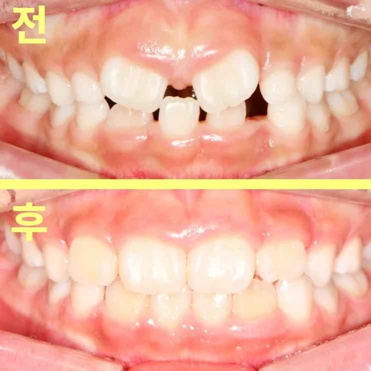 대구교정치과 아이 앞니 교정 언제 시작할까요