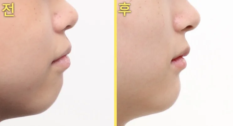 대구교정치과 혀 내미는 습관이 얼굴형을 바꿀 수 있나요?
