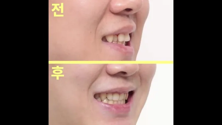 대구수성구치과 성인 유치와 영구치 결손, 교정부터 임플란트까지