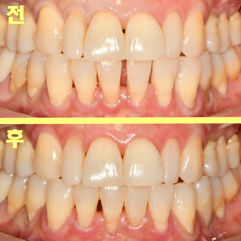 부분 교정 전후를 비교하는 환자의 정면 치아 사진으로, 교정 후 벌어진 앞니가 가지런해진 모습이 보인다.