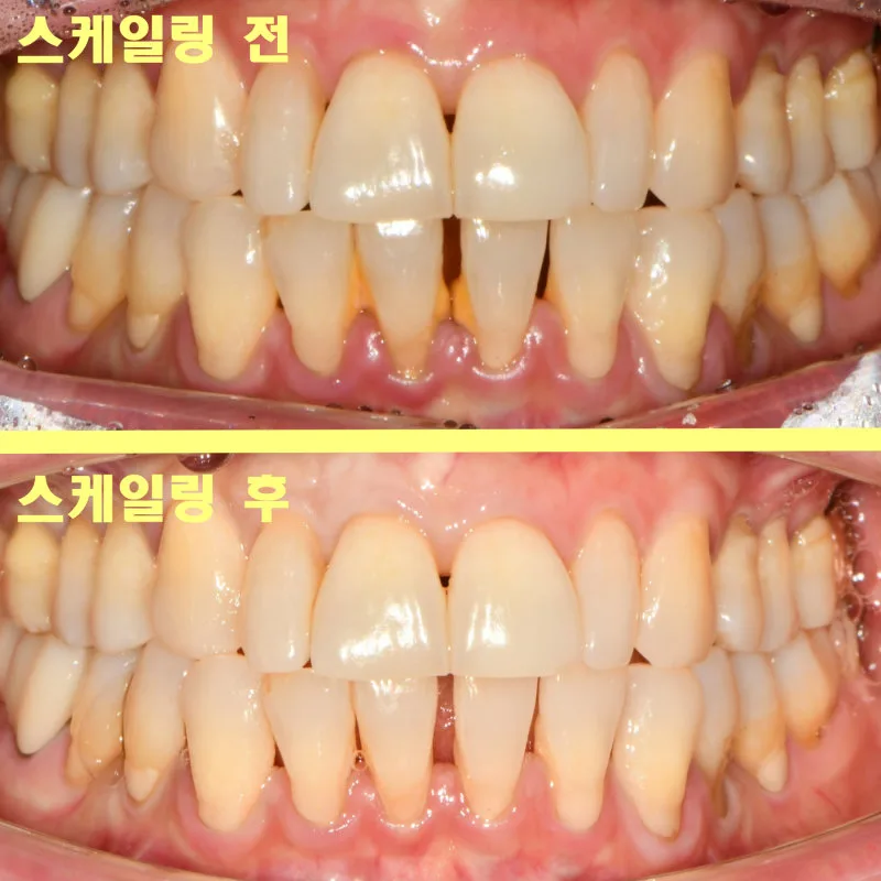 스케일링 전후를 비교하는 환자의 치아 사진으로, 스케일링 후 치석이 제거된 모습이 보인다.
