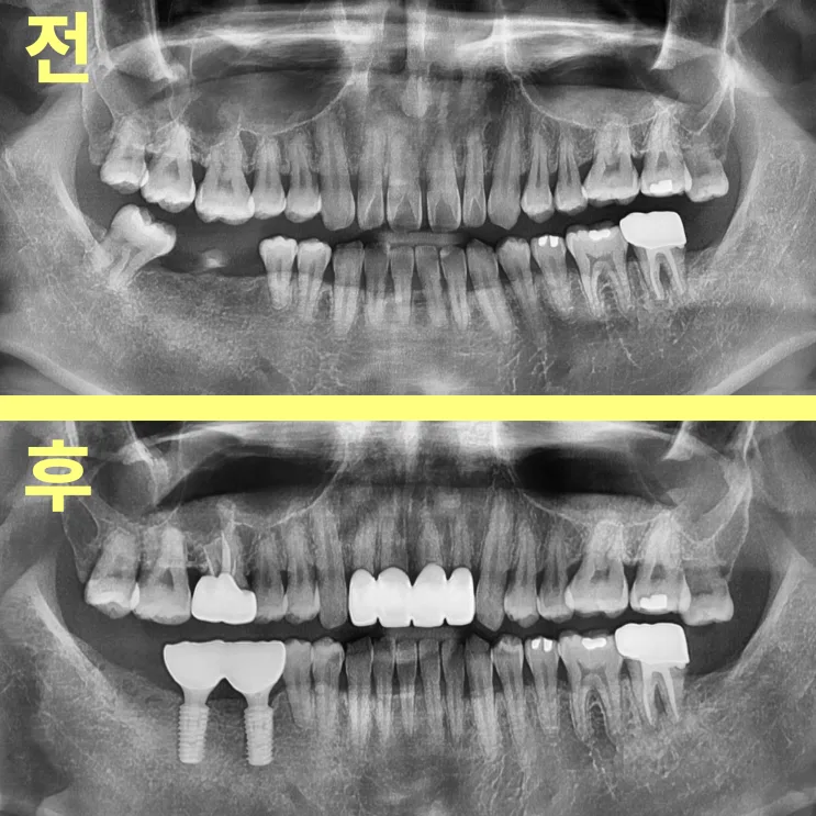수성구치과 40대 치아 벌어짐, 잇몸부터 봐야 하는 이유