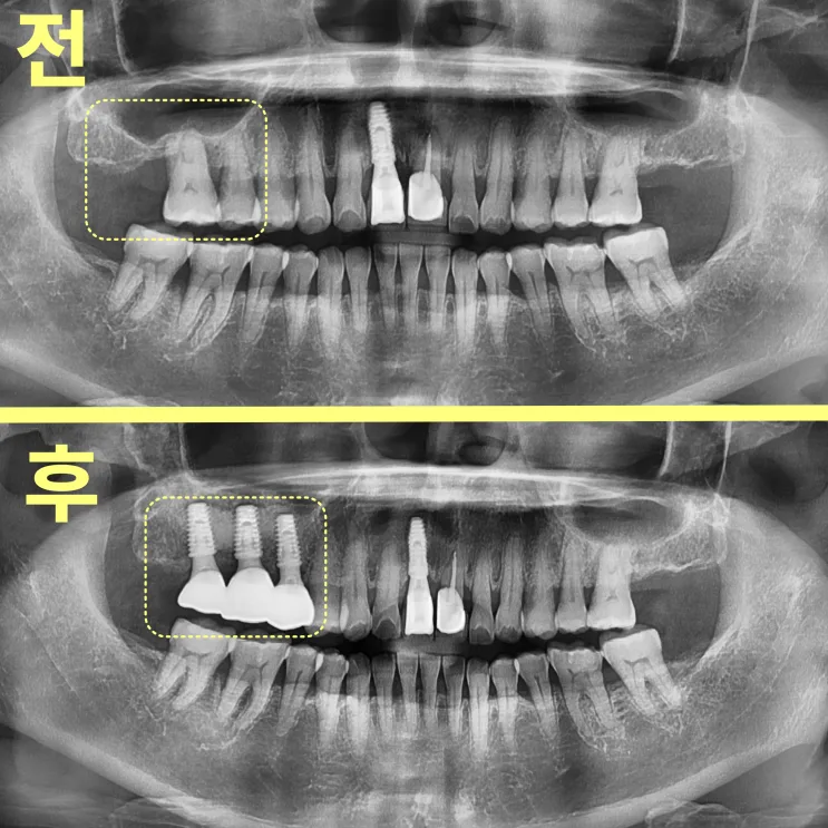 수성구치과 발치 후 빈자리 언제 메워야 할까요?