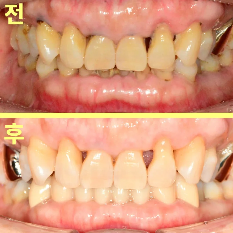 하악 전치부 치료 전후 정면 구강 내 사진 비교