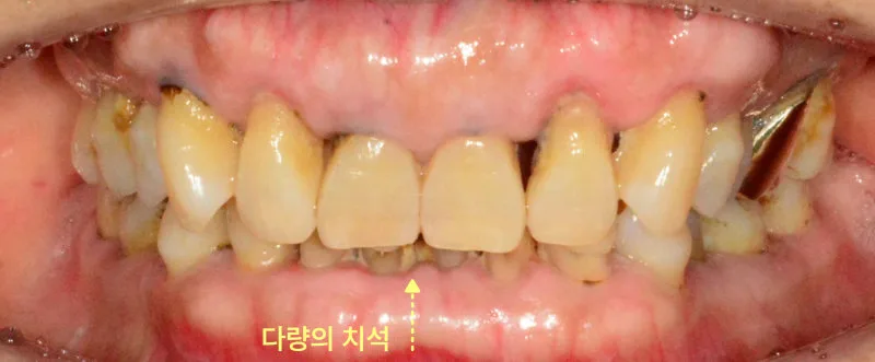 하악 전치부 치아의 정면 구강 내 사진, 다량의 치석이 관찰됨