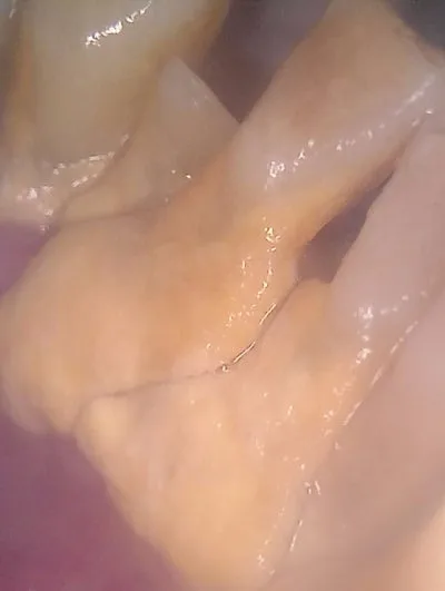 하악 전치부 치아의 설측면 근접 구강 내 사진, 치석이 관찰됨