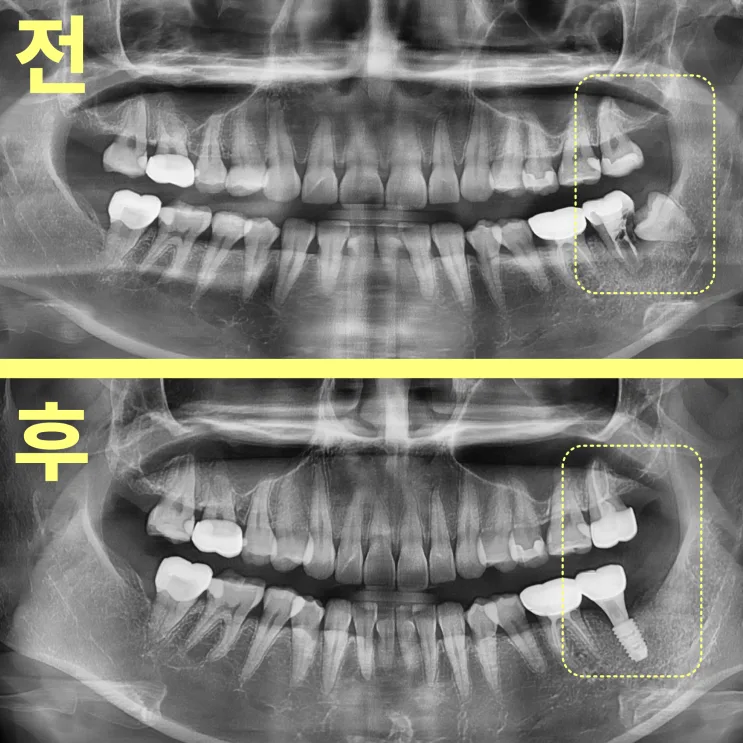 수성구치과 아프지 않은 어금니도 발치할까요?
