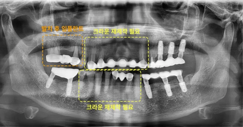 환자의 파노라마 방사선 사진. 상악과 하악에 임플란트 및 보철물이 보이며, 발치 후 임플란트, 크라운 재제작 필요 영역이 주황색 점선으로 표시되어 있다.